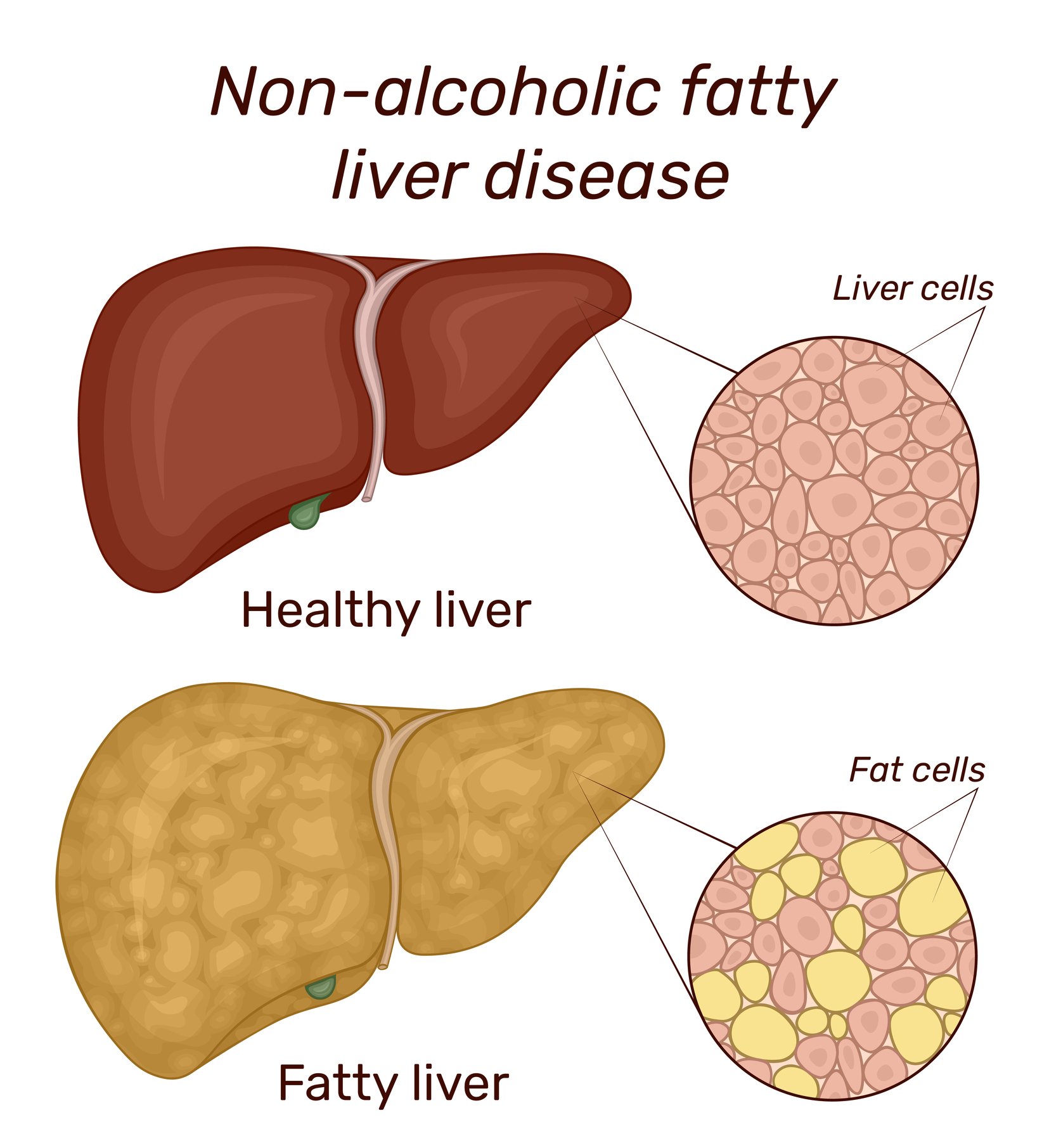 Non-Alcoholic Fatty Liver Disease Chart