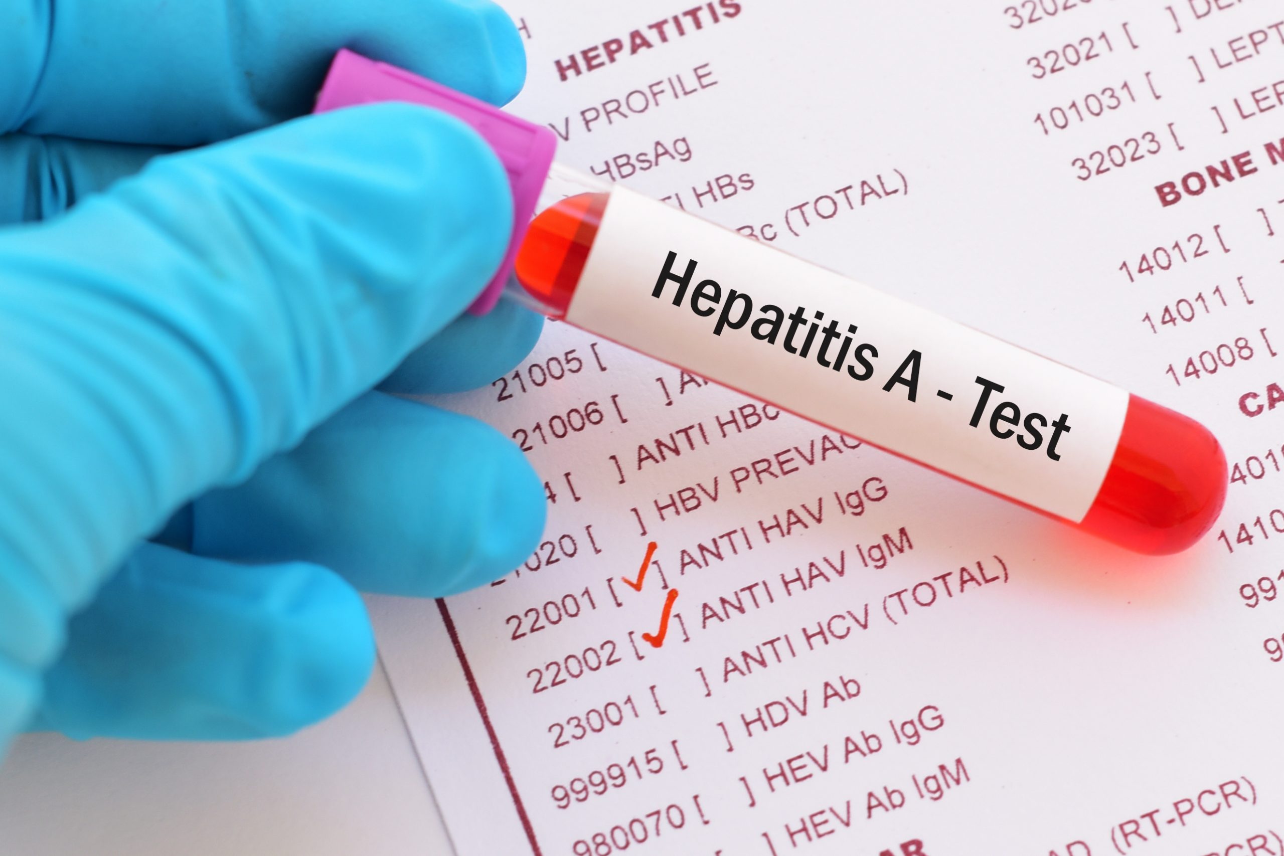 Hepatitis A Diagnosis and Treatment