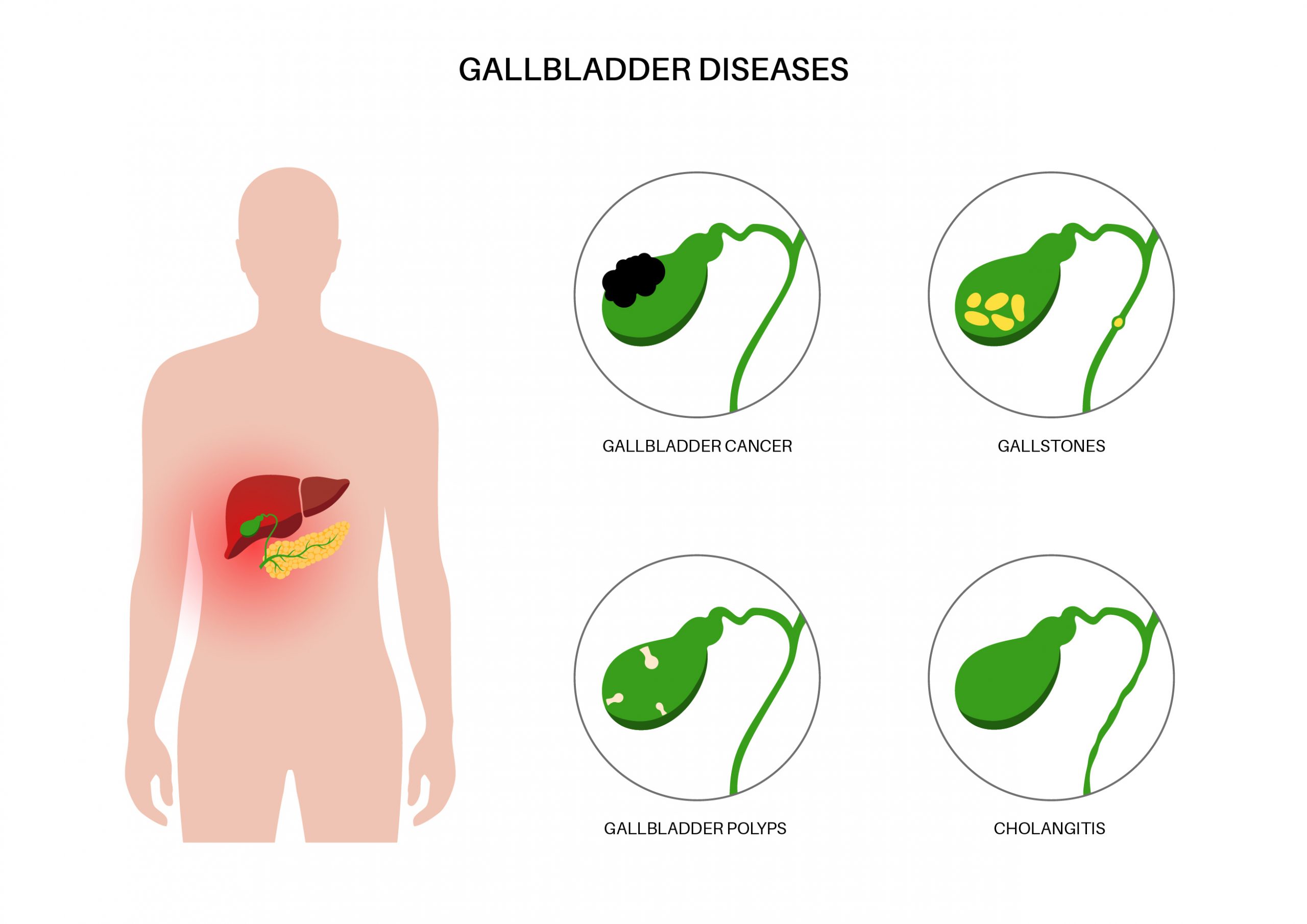 Issues Causing Gallbladder Pain